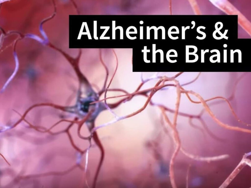 Taking on the Alzheimer’s Problem